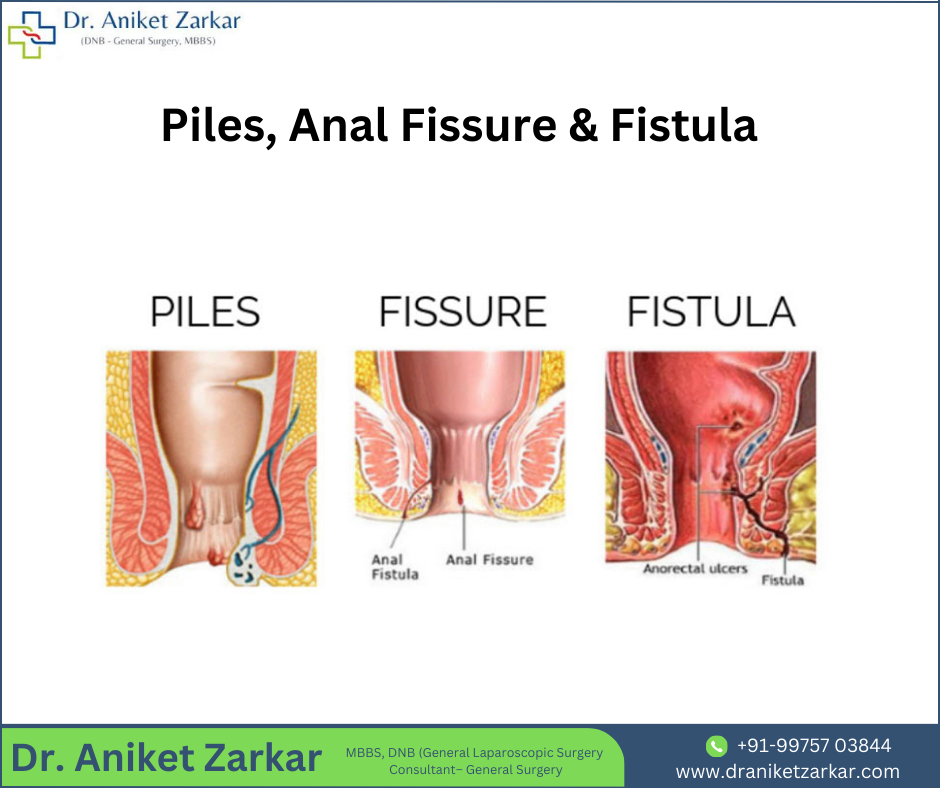 Best Laser Surgeon Offers Piles Fissure Fistula Treatment